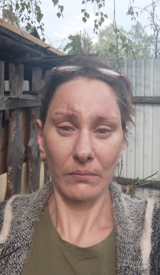 3 месяца после второй операции