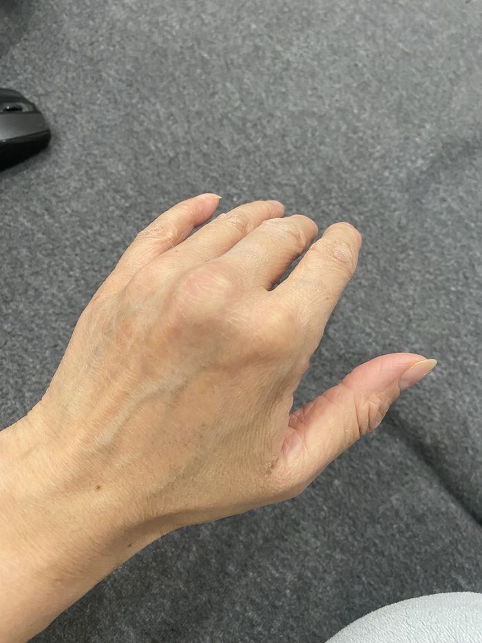 Левая рука держалась молодцом. Но месяц назад сустав среднего пальца начал пухнуть увы.