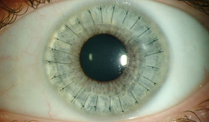    .      -      .    <a href="https://pikabu.ru/story/62_istorii_iz_zhizni_professionalnoe_zabolevanie_11107962?u=https%3A%2F%2Fkeratoconusa.net%2Fmetodi-lecheniya-keratoconusa%2Fkeratoplastika-pri-keratokonuse.html&t=%D1%81%D0%BA%D0%B2%D0%BE%D0%B7%D0%BD%D1%83%D1%8E%20%D0%BA%D0%B5%D1%80%D0%B0%D1%82%D0%BE%D0%BF%D0%BB%D0%B0%D1%81%D1%82%D0%B8%D0%BA%D1%83&h=08eda4e134bfe36d0c98b98c4d82f63f7f6b1aa7" title="https://keratoconusa.net/metodi-lecheniya-keratoconusa/keratoplastika-pri-keratokonuse.html" target="_blank" rel="nofollow noopener"> </a> ()  .   1905 .  -.