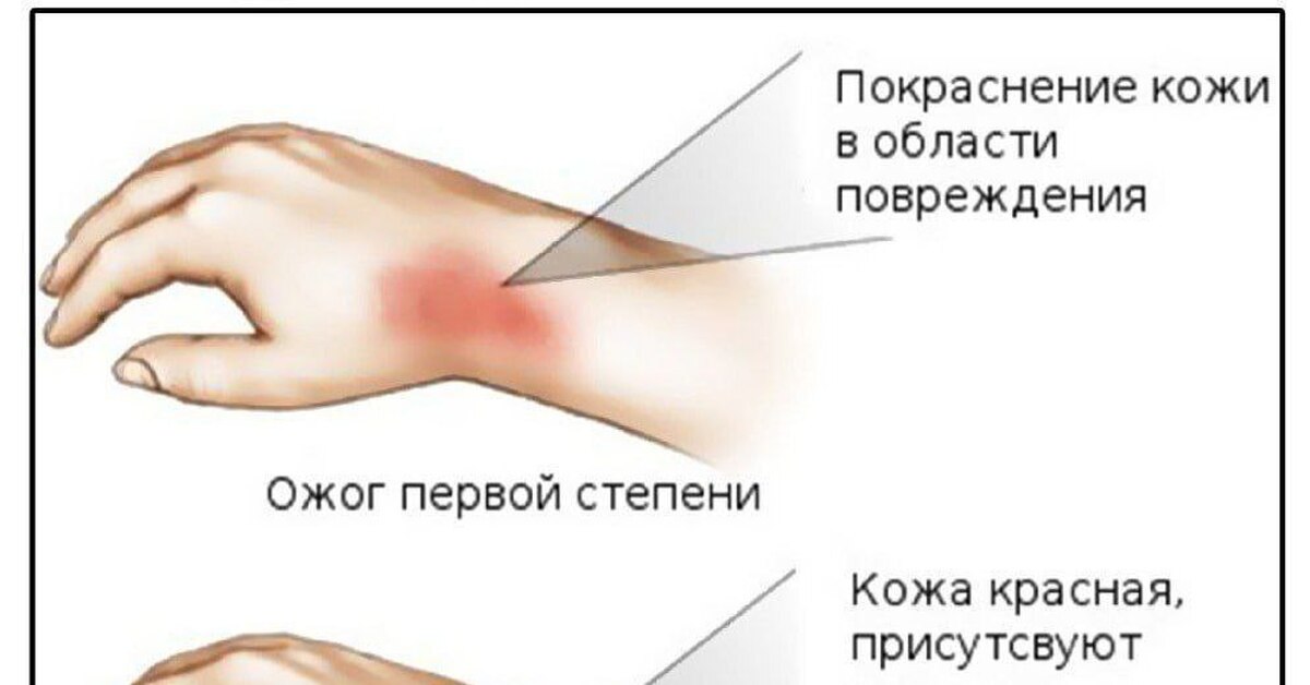 Определи степень ожога кожи правильно! | Пикабу