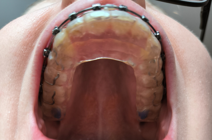 Сплинт. Вид снизу.