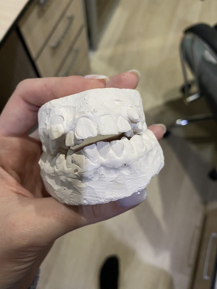 Начало История болезни, Зубы, Исправление прикуса, Длиннопост, Брекеты