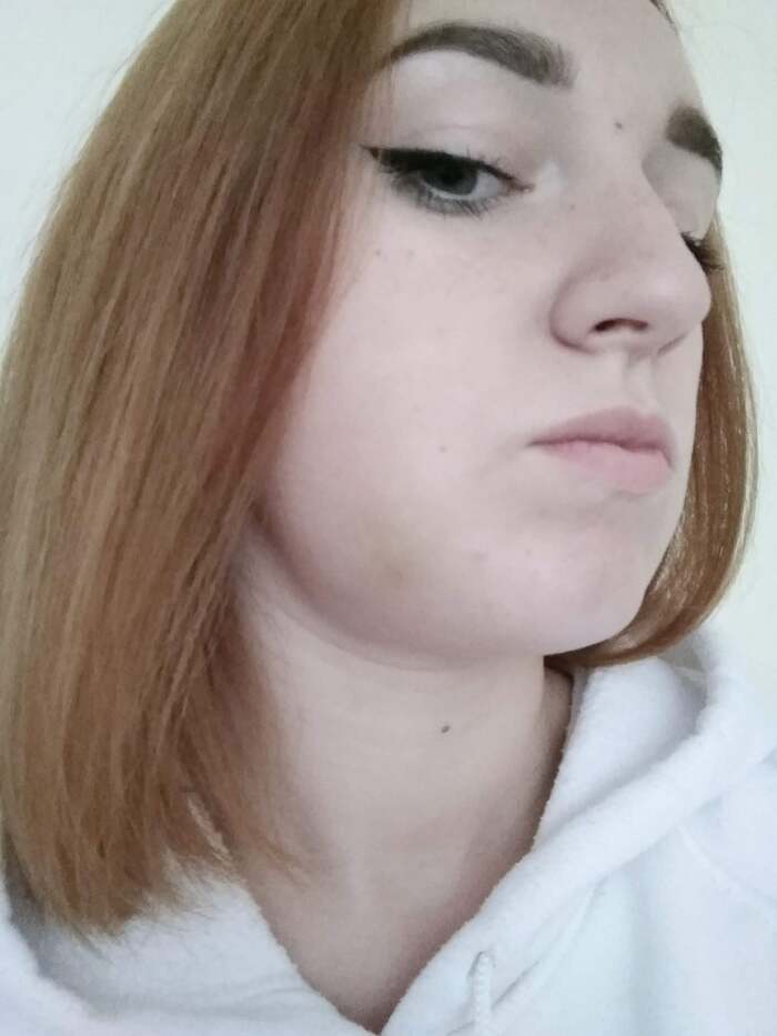 Начало История болезни, Зубы, Исправление прикуса, Длиннопост, Брекеты