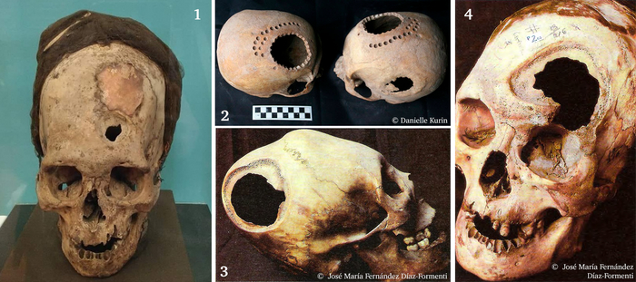 1 — Отверстие заделано золотым листом; 2 — Следы тренировок местных врачей на черепах умерших людей; 3, 4 — Отверстия от смертельных трепанаций