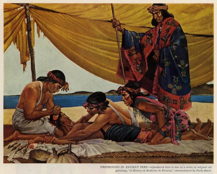 Сцена трепанации в представлении художника. Можно только догадываться о том, какую палитру эмоций и чувств испытывал пациент за 2000 лет до изобретения анестезии / Robert Thom, “Trephining in Ancient Peru”