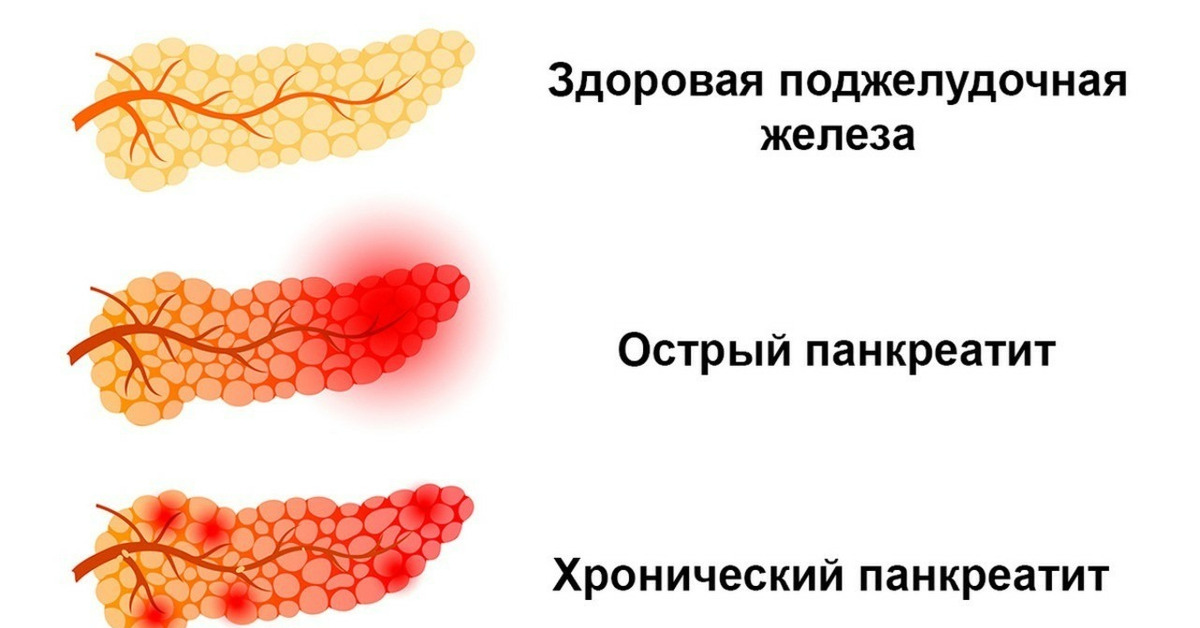 Панкреатит Фото Симптомы