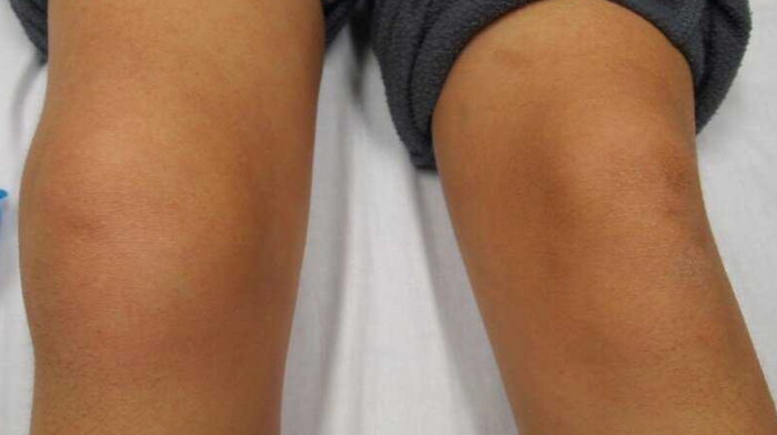 Синовит правого коленного сустава.