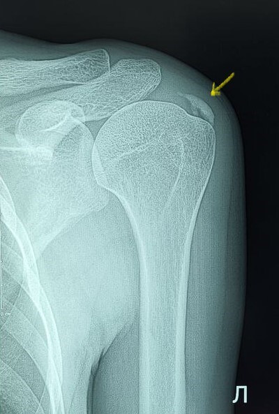 Тендинит сухожилия надостной мышцы плечевого сустава Медицина, Рентгенология, Суставы, Военкомат, Рентген