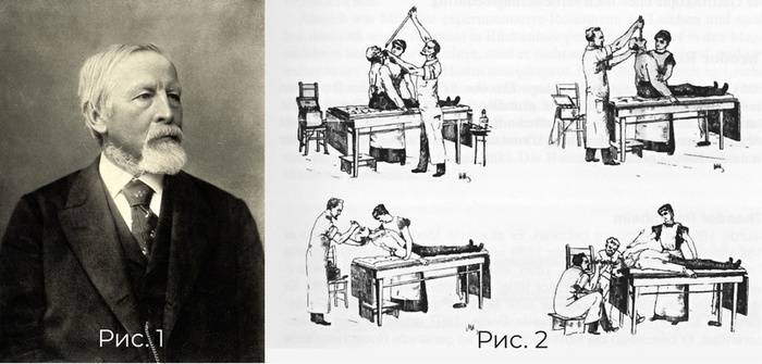 Рис. 1 Доктор Адольф Куссмауль ( 22.02.1822 — 22.05.1902). Рис. 2 Гастроскоп Куссмауля, 1868г. (Из книги Эдмонсона Дж.М. История инструментов для желудочно-кишечной эндоскопии. Gastrointest Endosc 37 S30, 1991.)