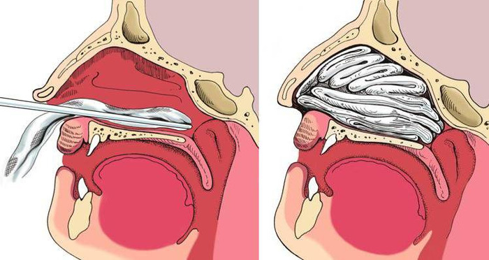 Передняя тампонада носа