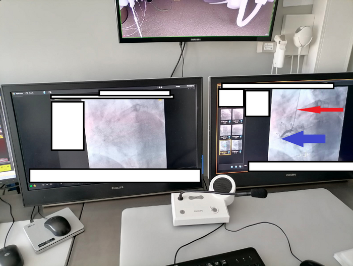 Как проводится коронарное стентирование