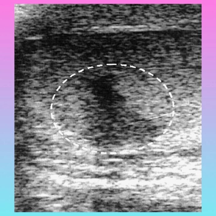 Figure 1. УЗИ скан повреждённого яичка.