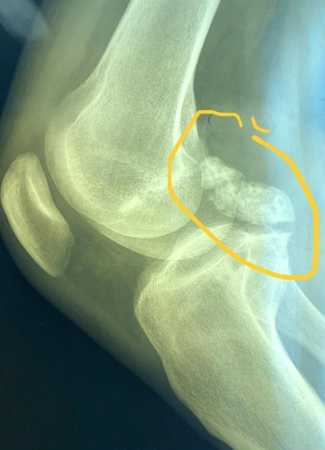 Хондромные тела в полости коленного сустава.