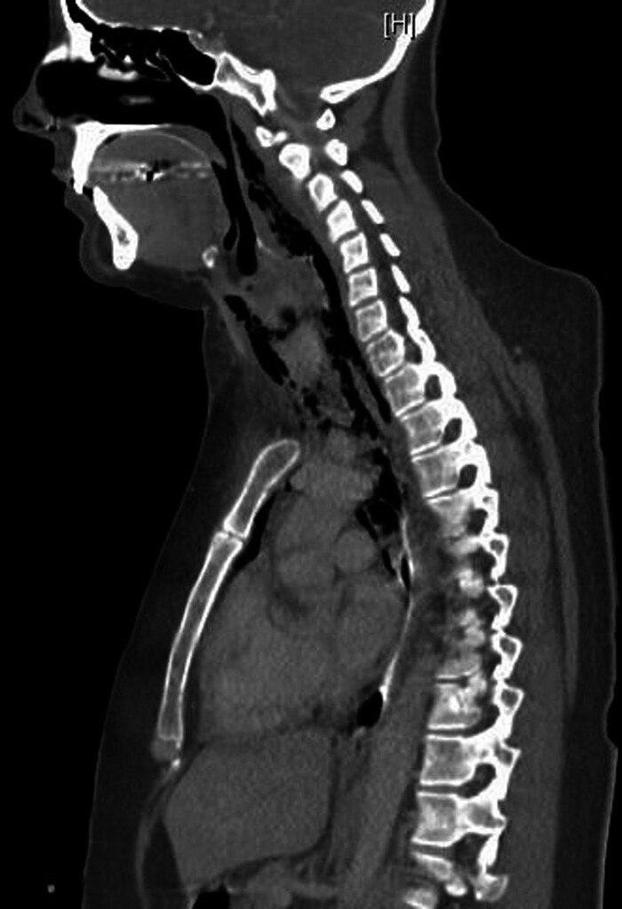 Figure 2. Компьютерная томография в сагиттальном разрезе демонстрирует наличие внепросветного воздуха, распространяющегося от уровня носоглотки до средостения.