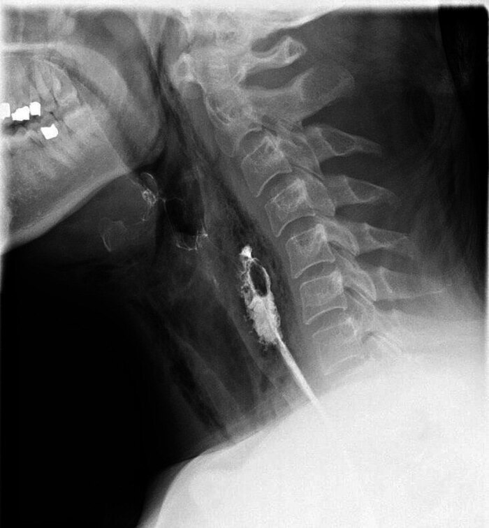 Figure 3. Сагиттальный снимок, выполненный с контрастом, демонстрирующий утечку контраста в мягкие ткани на уровне гипофаринкса.