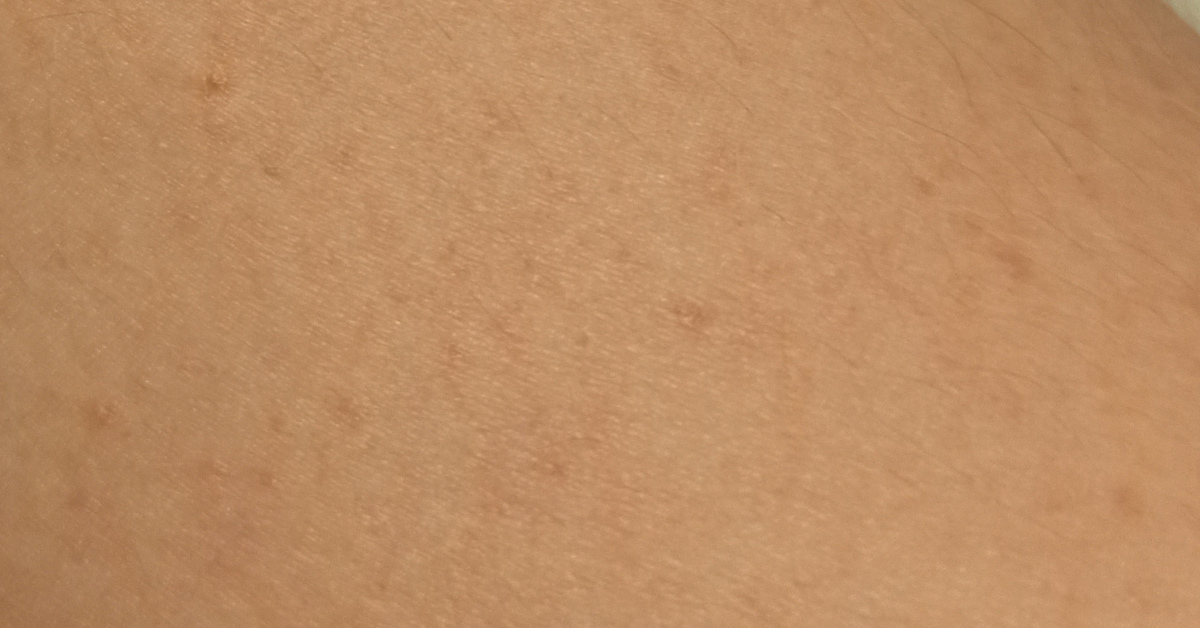 Возможно ли вылечить цыпки\\гусиную кожу\\потничку\\фолликулярный ...