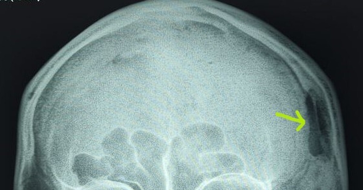 Дефект костей черепа после трепанации | Пикабу