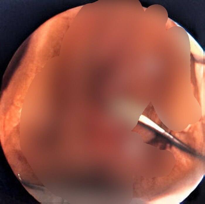 По понятным причинам данное фото опубликовать я не могу. Figure 2. Фотография, изображающая перегородчатую девственную плеву. Стрелка А - уретра; стрелка В - перегородчатая девственная плева.