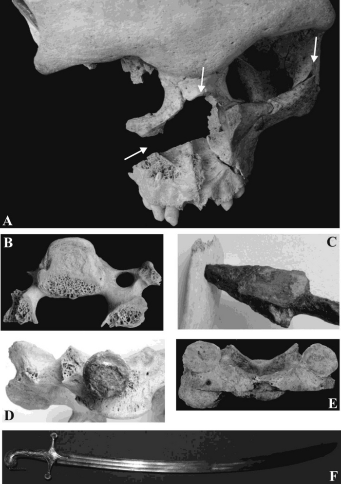  2: lesion 6,  ,    ,       (); lesion 11,   3-   (); lesion 13,       (); lesion 12, 4-    