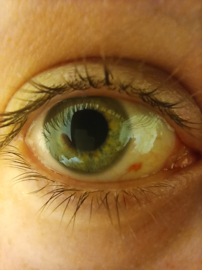 Мой глаз на 2 сутки после Lasik, снизу справа видно красное пятно - это кровоизлияние, которое само пройдёт, как синяк на коже.