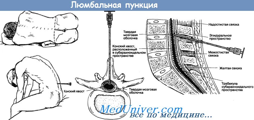 Постпункционная головная боль | Пикабу