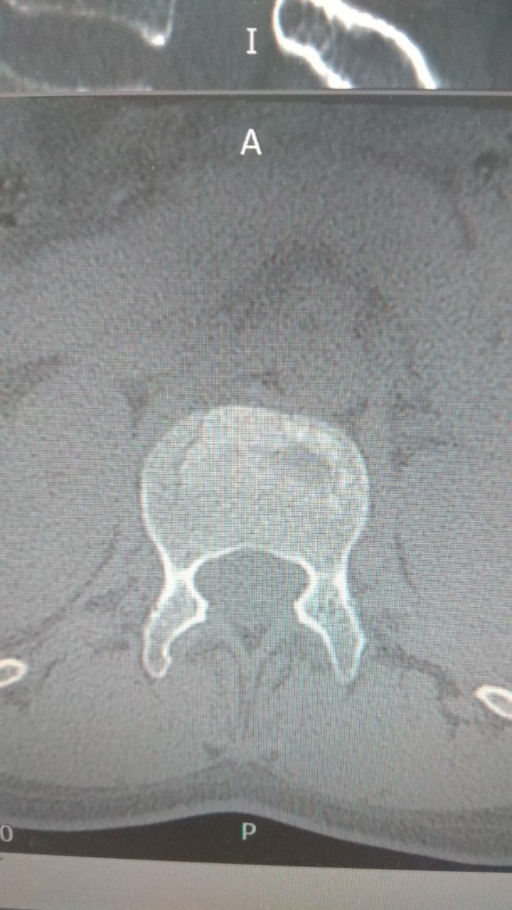 Компрессионный перелом позвоночника l1 - нужна помощь и консультация 2 |  Пикабу