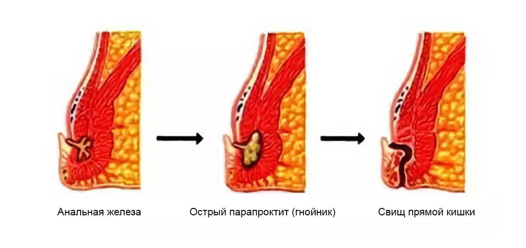 Как вылечить геморрой