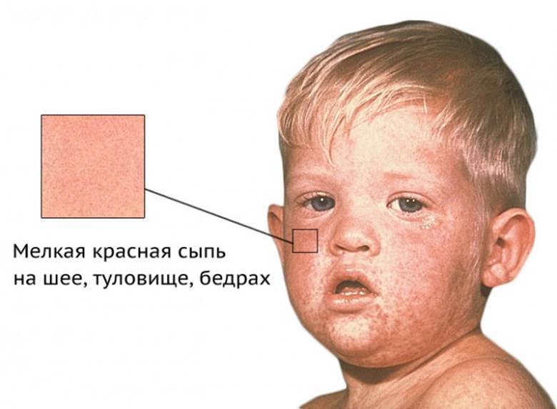 Инфекционная эритема (парвовирусная инфекция B19)