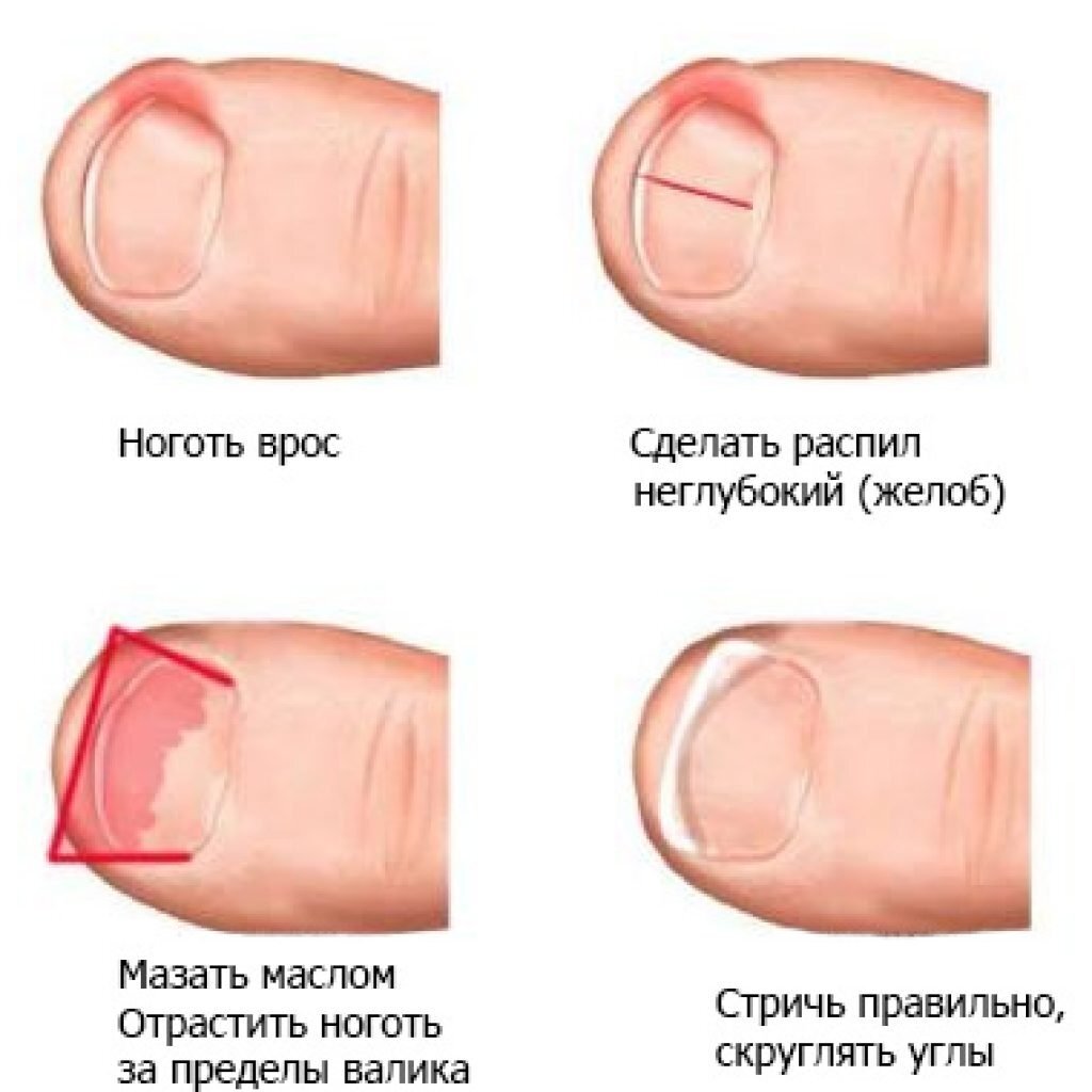 Ответ GrigoryOrloff в «Удаление вросшего ногтя» | Пикабу