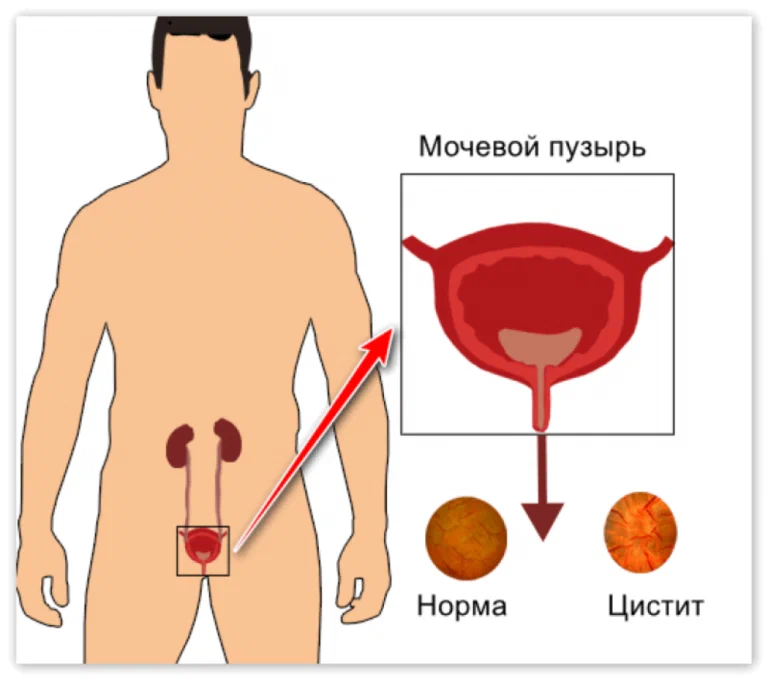 Ли после цистита. Цистит воспаление мочевого пузыря.