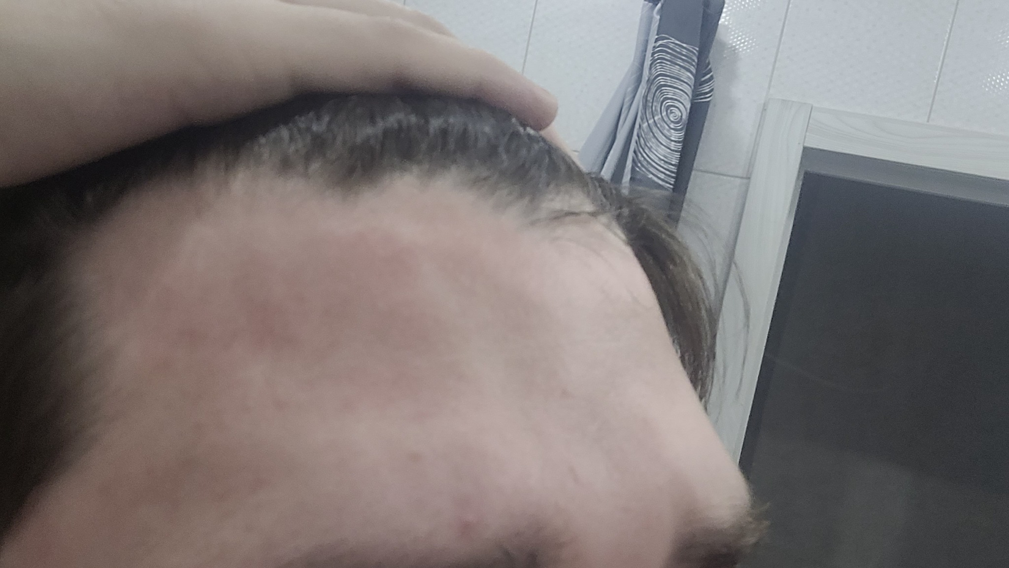 Помогите с аллергией | Пикабу