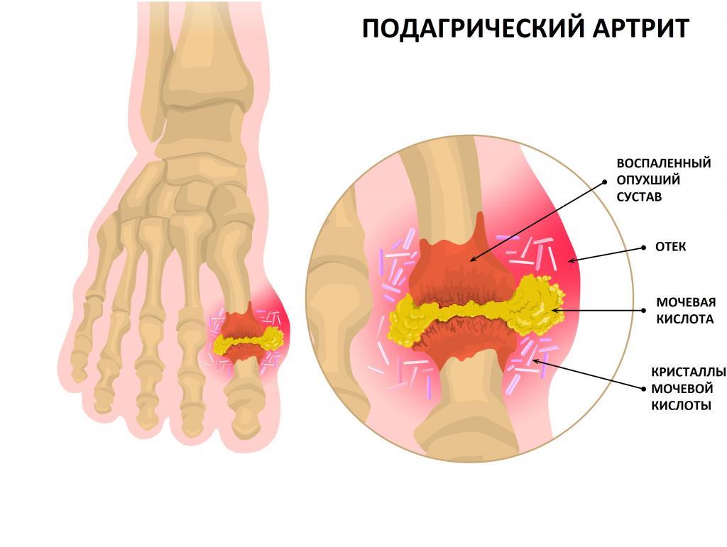 Ответ на пост «Тофусы при подагре - что это?» | Пикабу