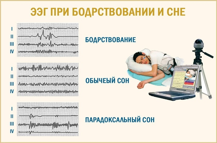 Согласно версии назначение быстрого сна. Электроэнцефалография сна. ЭЭГ сна. Фазы сна на ЭЭГ. ЭЭГ мониторинг сна.