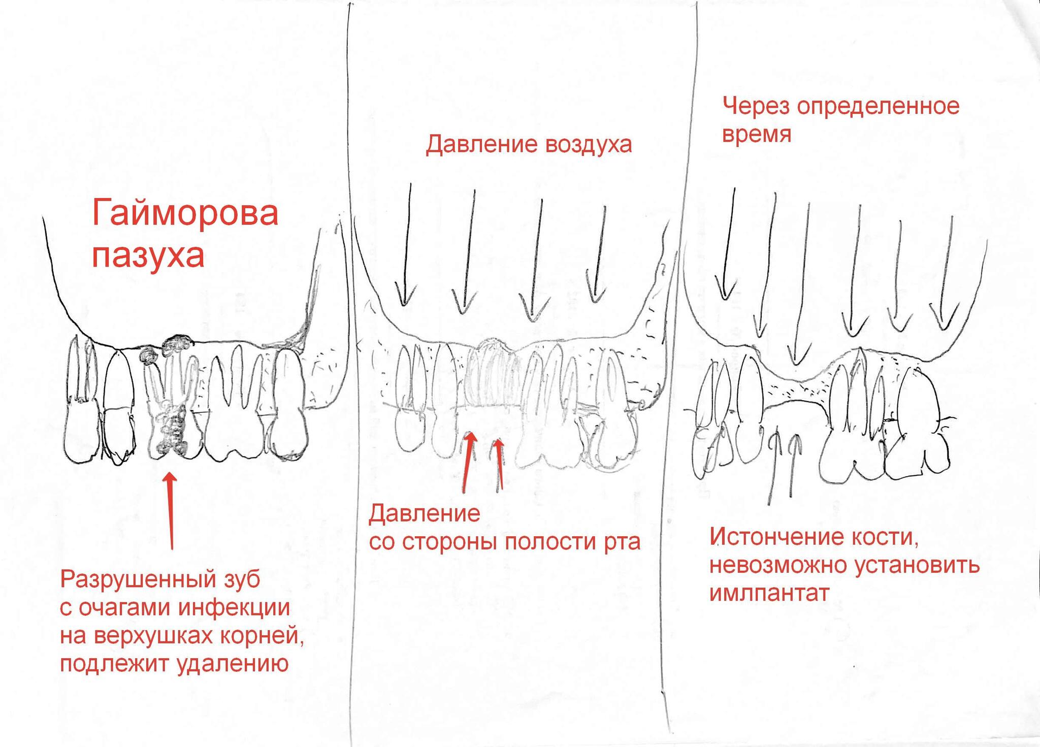 Сага о стоматологии. Глава 44. Как делают синус-лифтинг для установки  зубных имплантов? | Пикабу