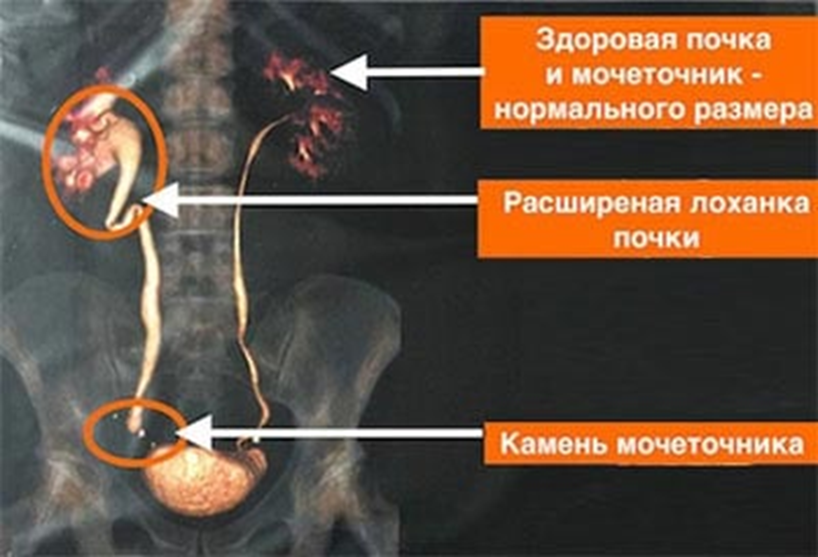 Ответ на пост «Мочекаменная болезнь» | Пикабу