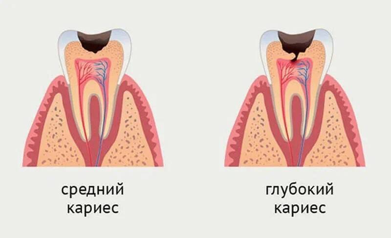 Беременность и зубы | Пикабу