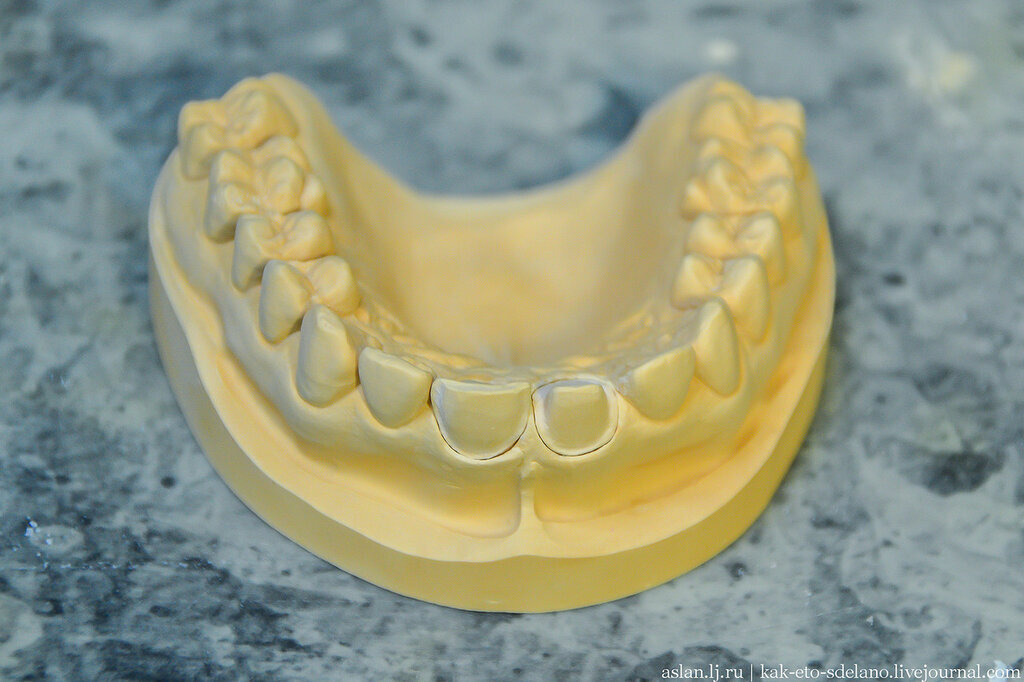 Как делают виниры и коронки | Пикабу
