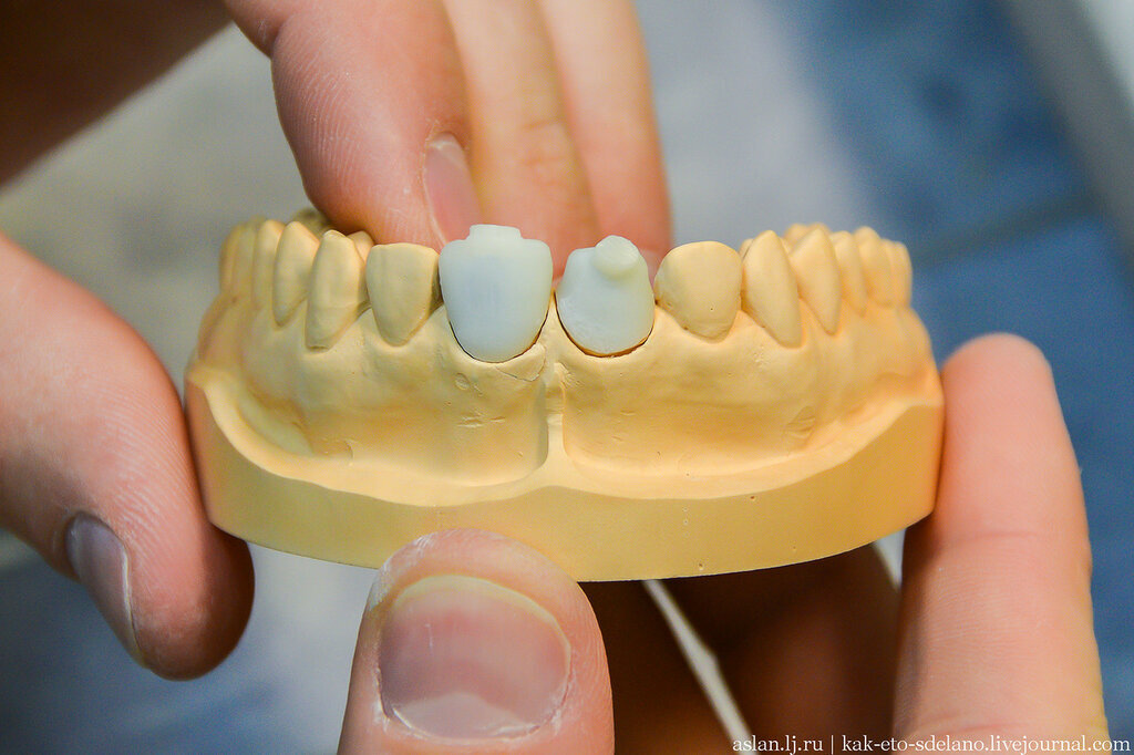 Как делают виниры и коронки. Часть 3 | Пикабу