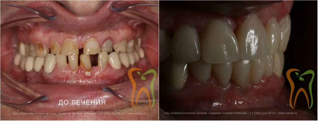 Как делают виниры и коронки. Часть 3 | Пикабу