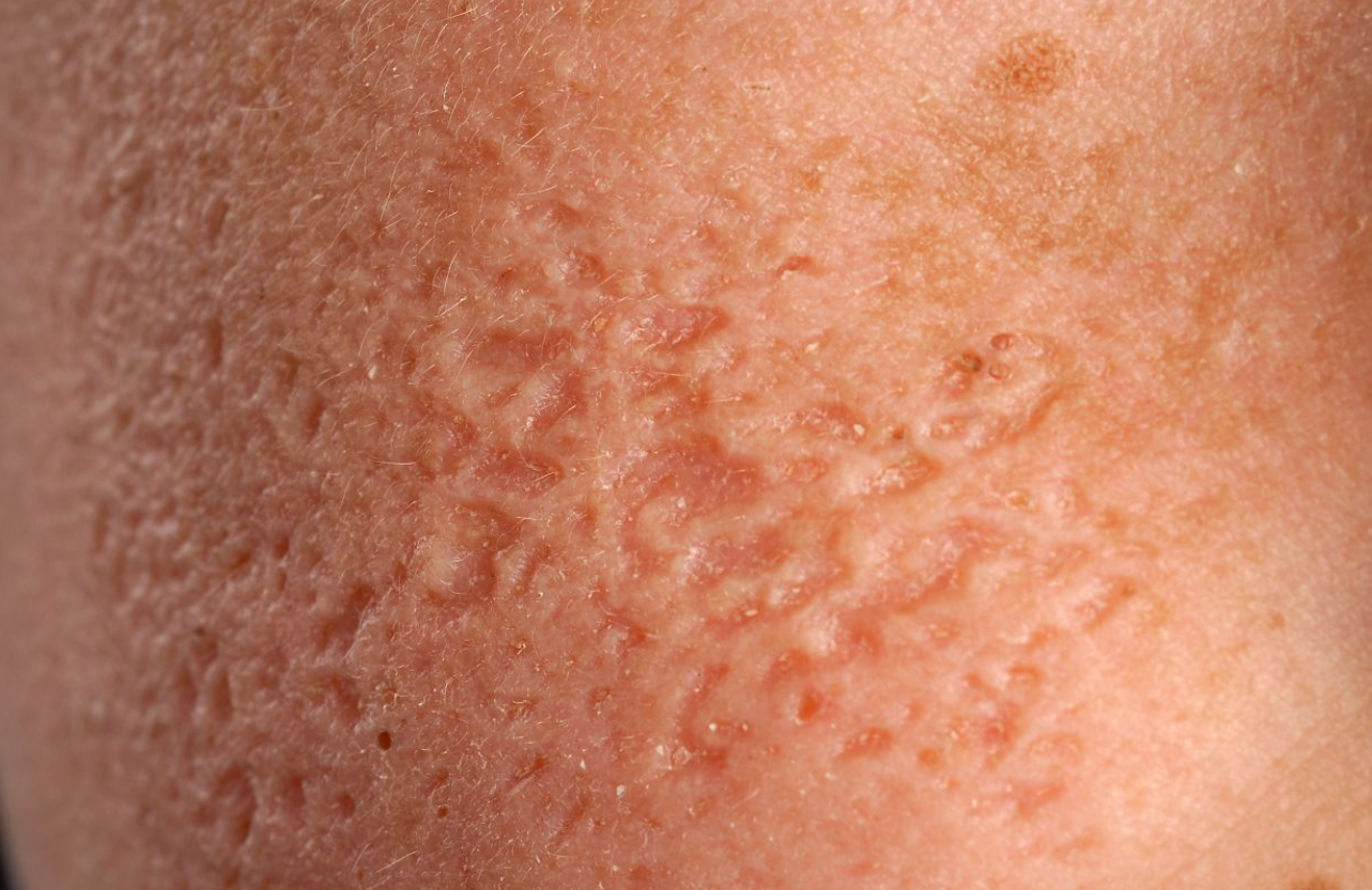 Гусиная кожа - что это, причины появления и способы лечения