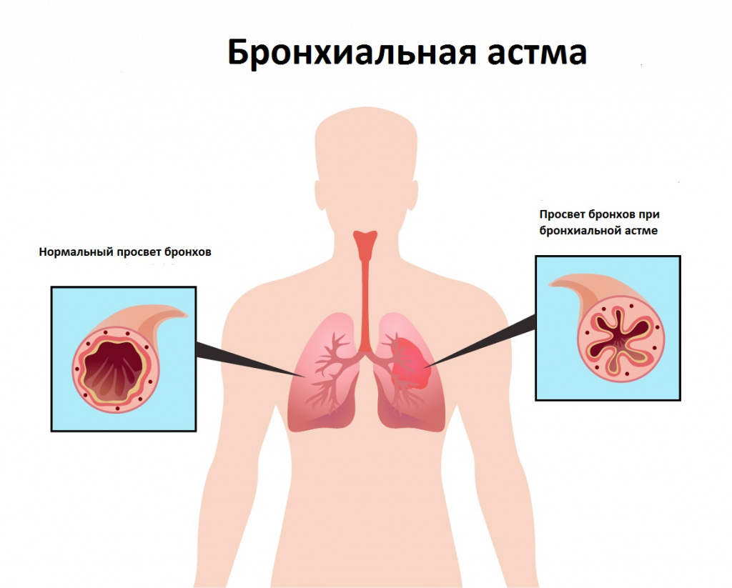 ОТличаем сухой кашель от влажного | Пикабу