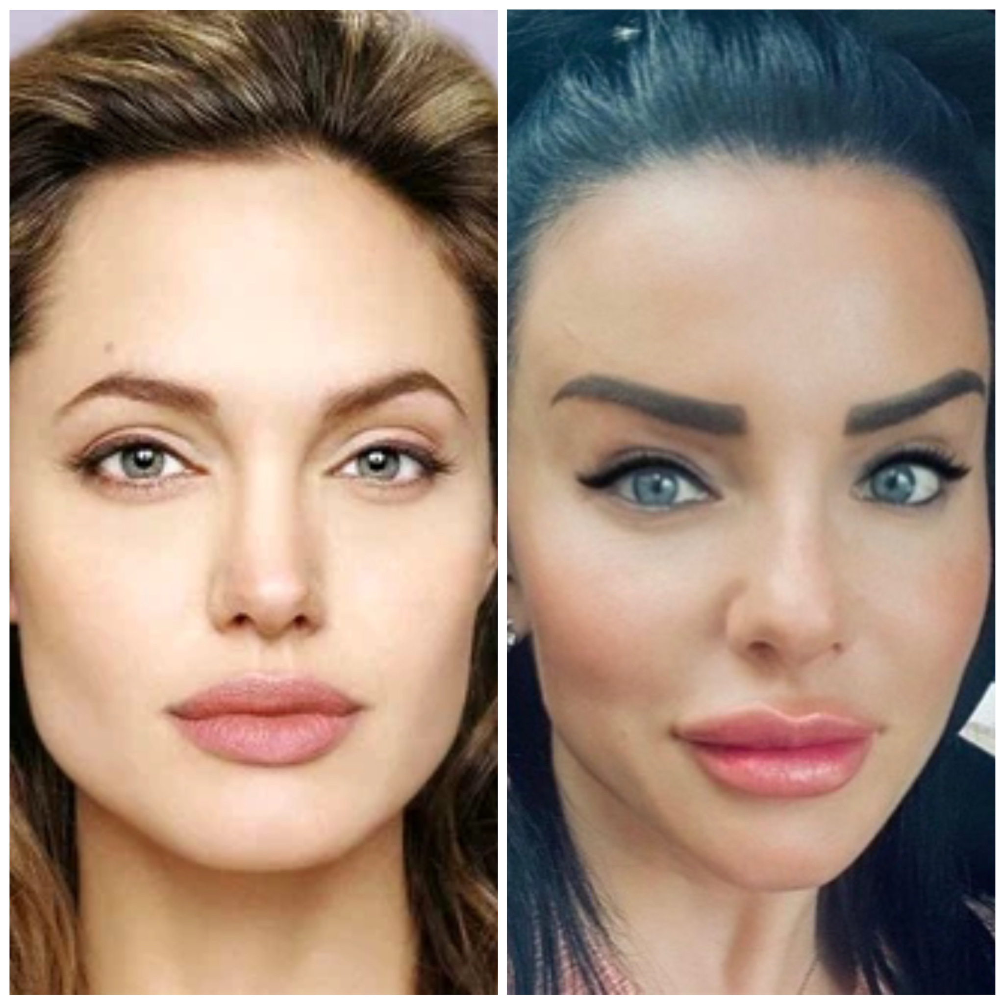 Фото «до и после» увеличения больших половых губ