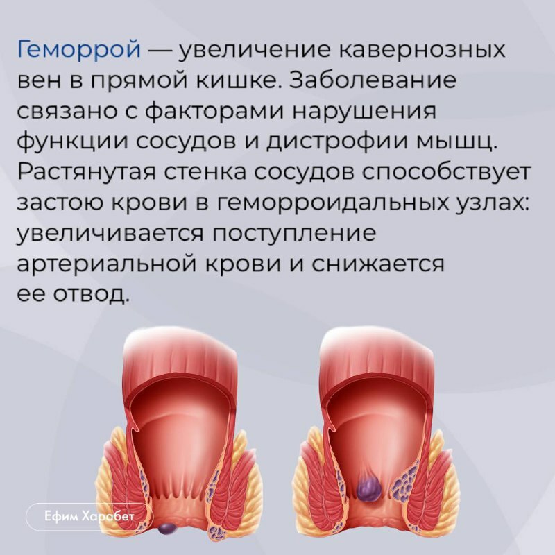 Геморрой 