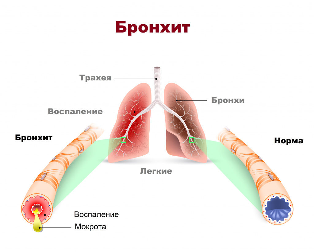 Бронхит. Ингаляции можно не разделять и делать при температуре | Пикабу