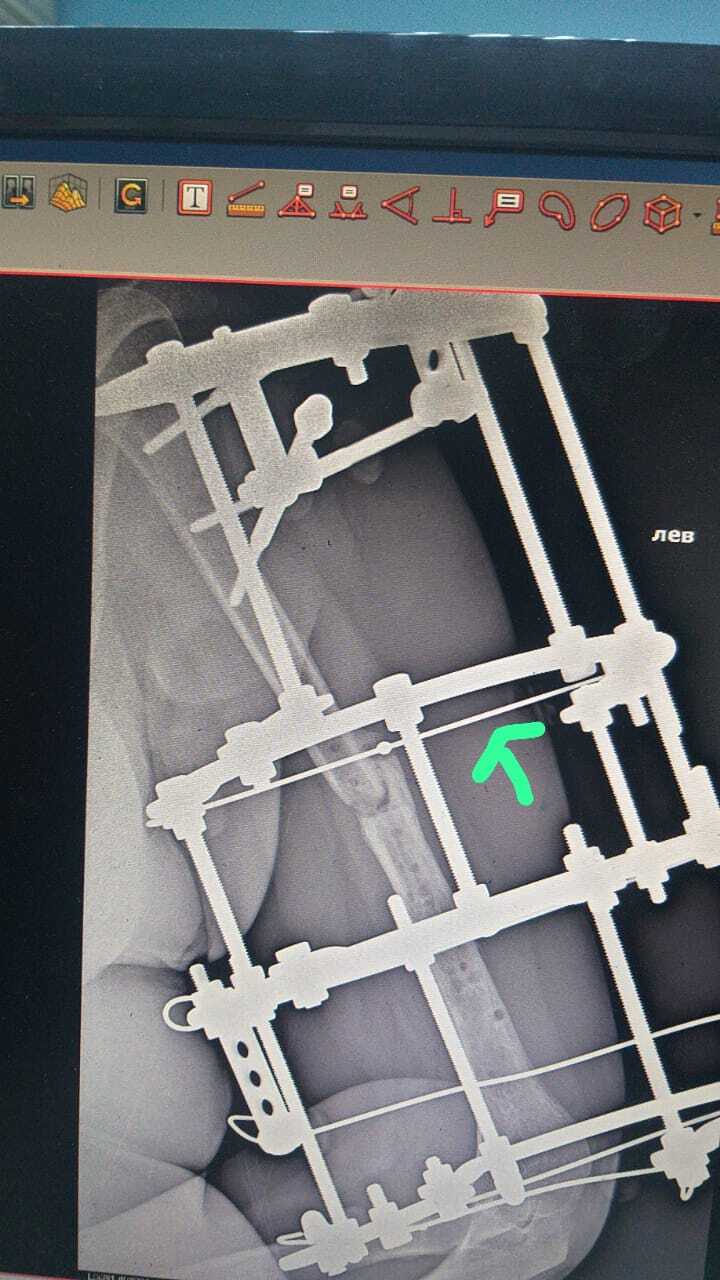 Аппарат Илизарова перелом плечевой кости. 3 операции. 2 из них были  пластины и последняя аппарат | Пикабу