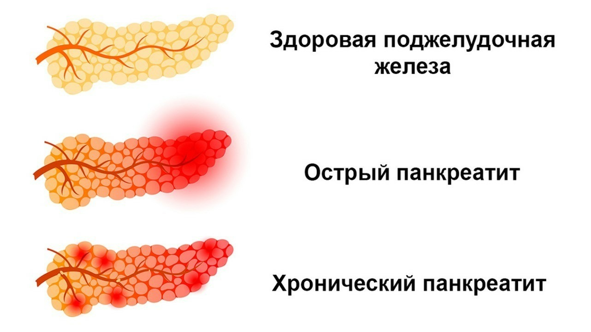 Панкреатит | Пикабу