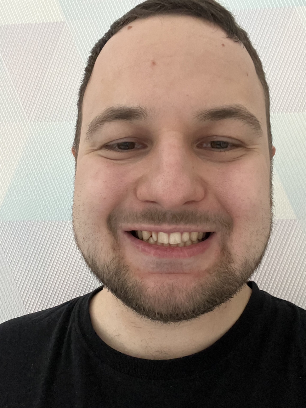 Сага о стоматологии. Глава 76. Как быстро и дешево восстановить зубы ...