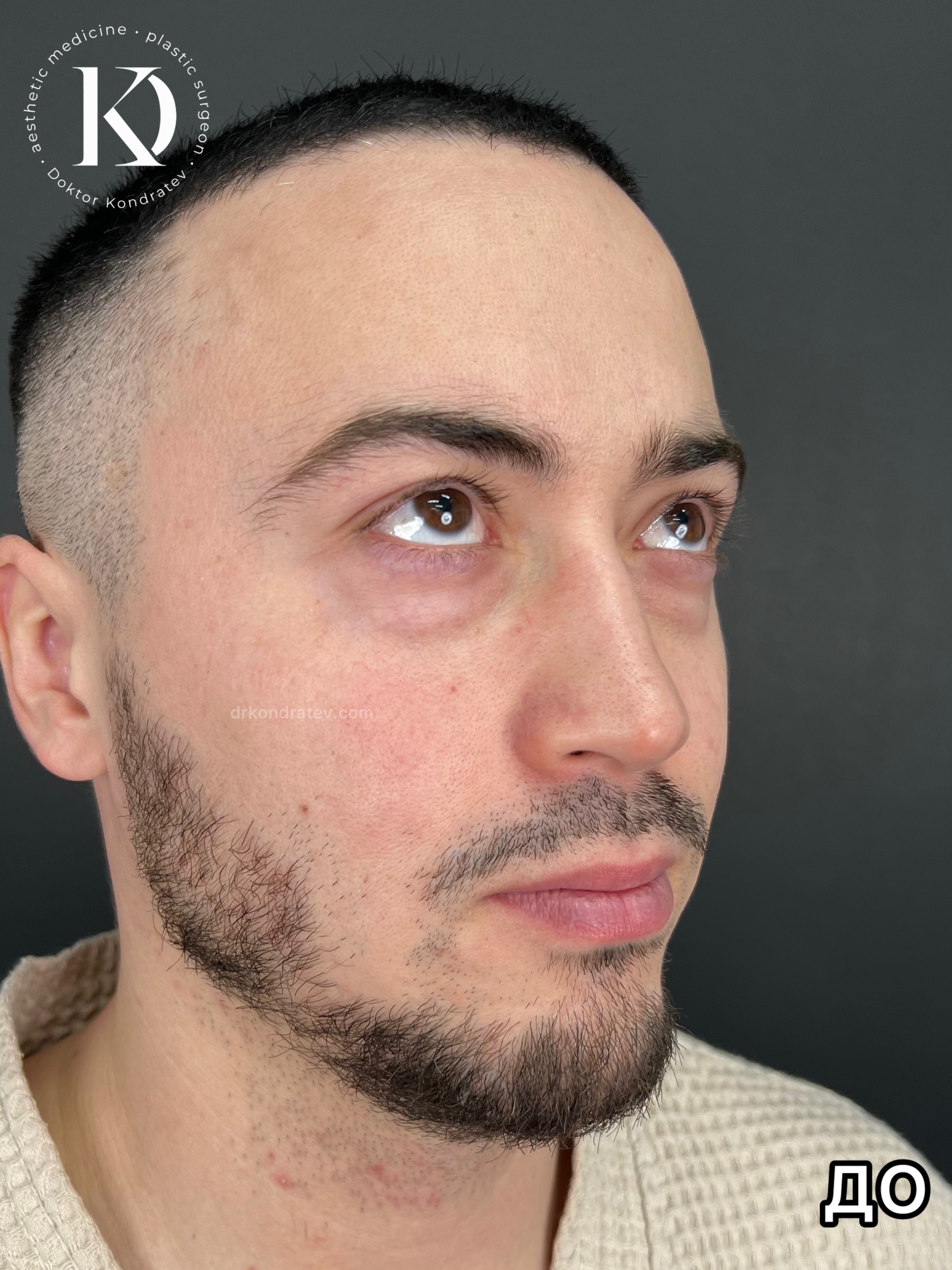 Мужская блефаропластика из 34 в 24? | Пикабу